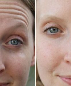 Facial Line Treatment with Allergan