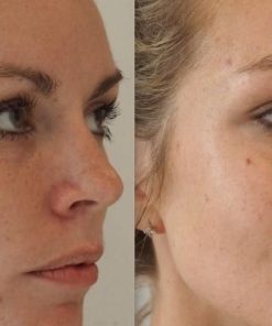 Cheek Enhancement Fillers