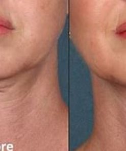 Deso Face/Chin Fat Reduction Treatment