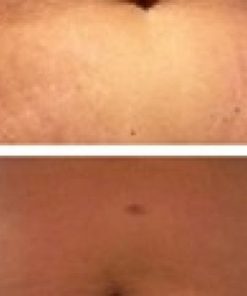 Deso Body Fat Reduction Treatment