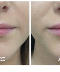 Dermal Filler Lip Enhancement