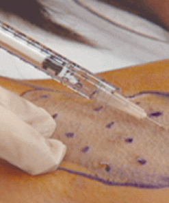 Hyperhydrosis (Sweating Treatment)